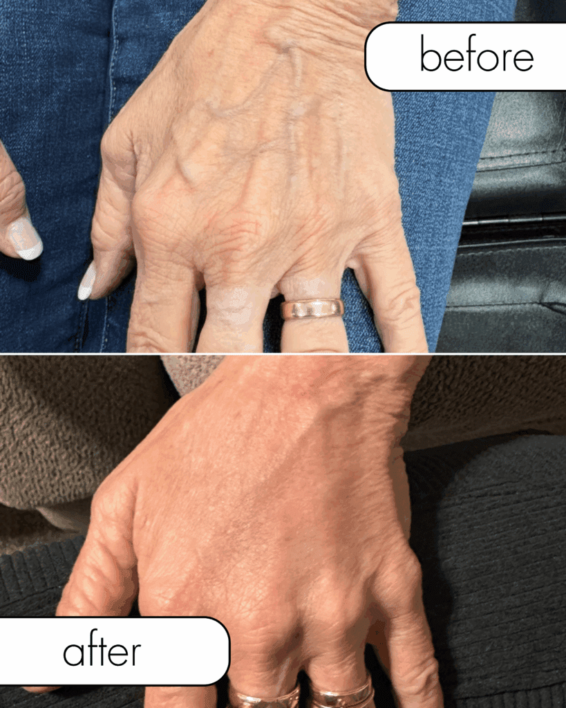 Before and after photos showing hands treated with hyperdilute Radiesse to improve skin thickness, smoothness, and reduce visible veins at The Injectables Lounge in Fishers Indiana