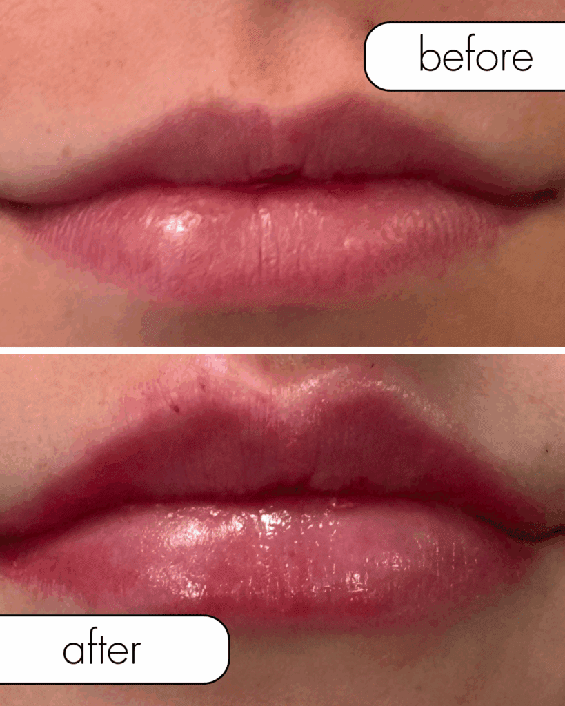 Before and after filler from The Injectables Lounge