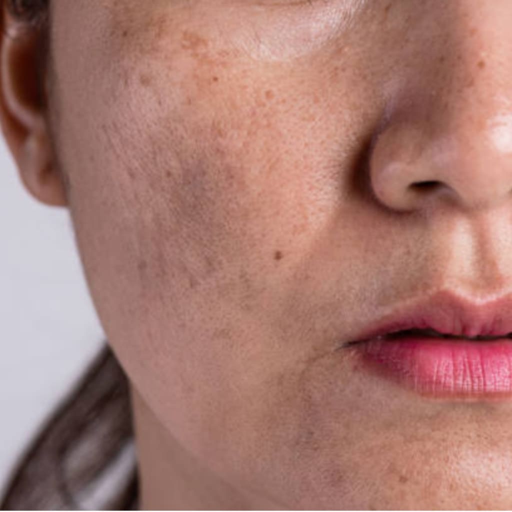 Close-up of a woman’s cheek showing post-inflammatory hyperpigmentation (PIH) — flat brown spots left behind after acne, visible on otherwise clear skin under natural lighting.