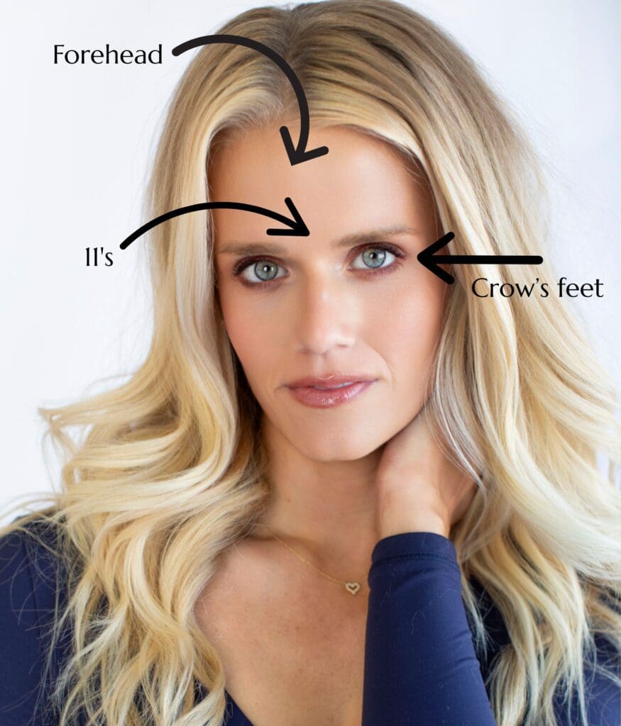 Illustration of a woman’s wrinkle-free face with labeled areas showing forehead lines, frown lines (11s), and crow’s feet, used to educate on Botox treatment zones.