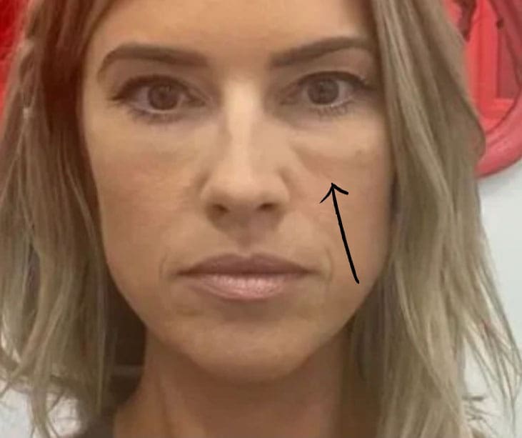 Celebrity tear trough filler that has led to excess swelling under the eye