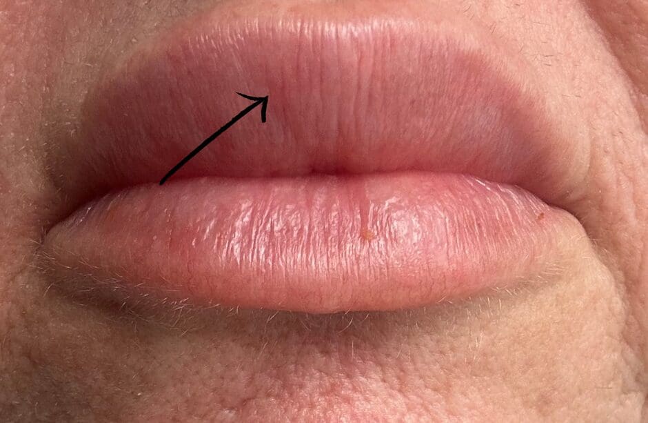 Distortion of Cupid's bow due to excess filler