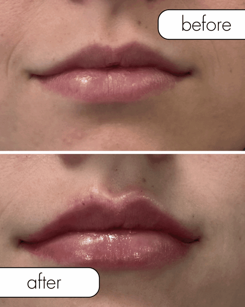 Lip filler before and after. Subtle anatomy driven results