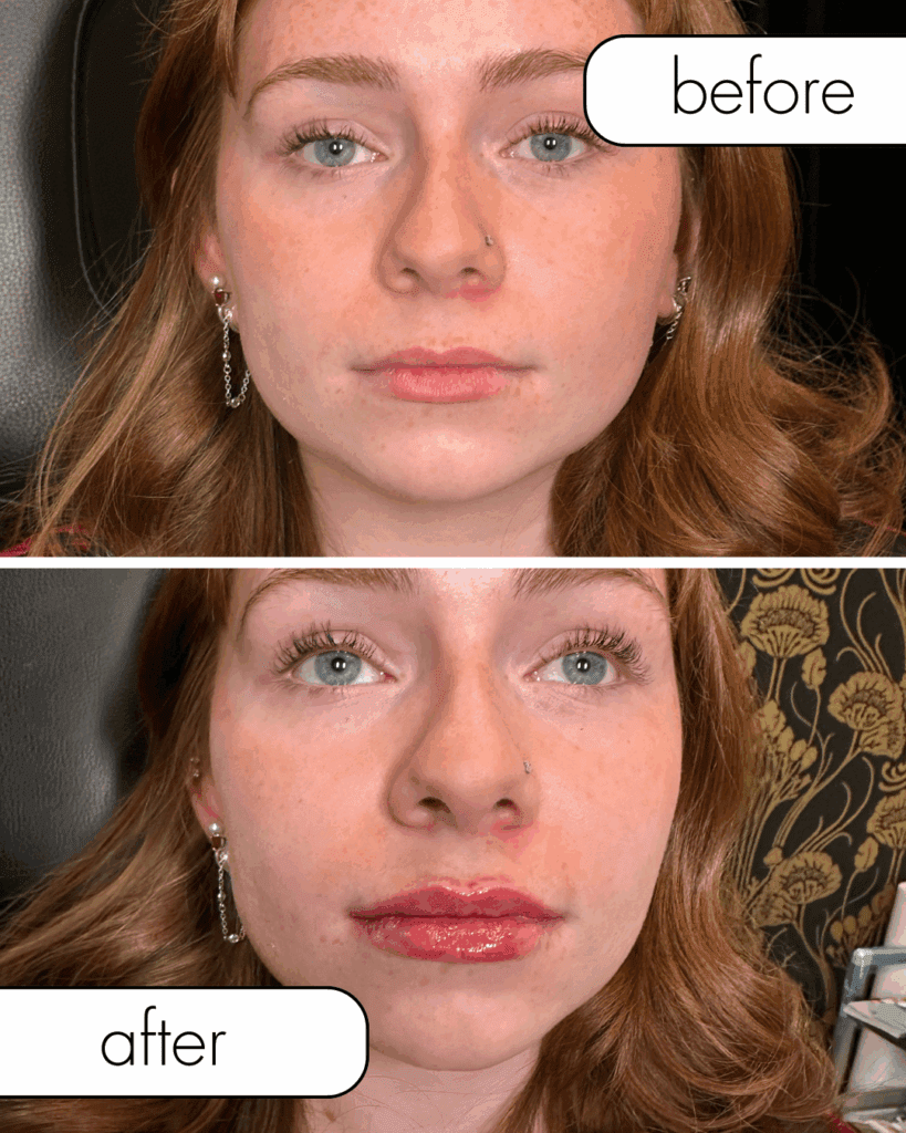 Lip filler before and after. Subtle anatomy driven results
