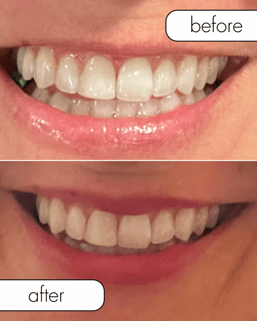 Lip flip before and after