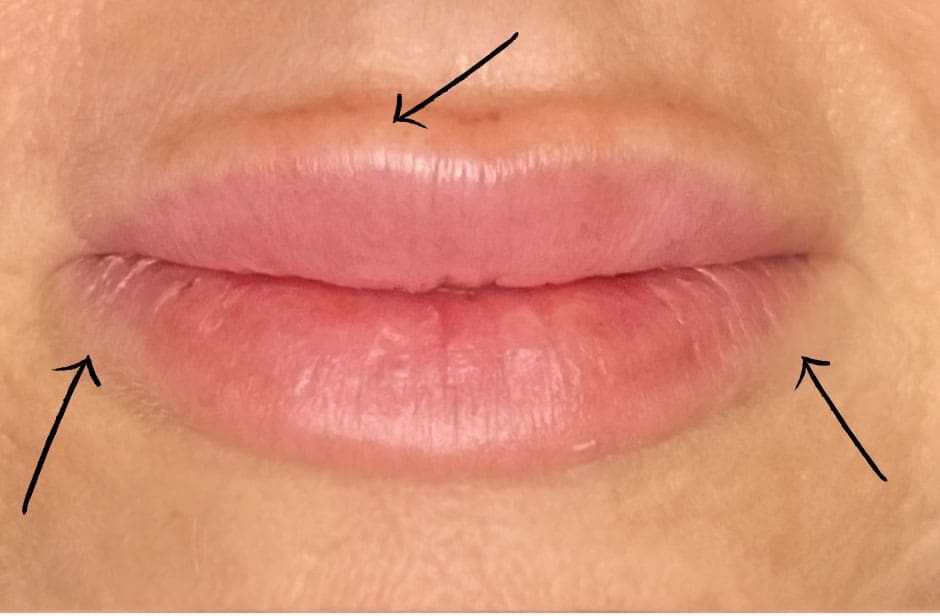Example of filler migration in the lips