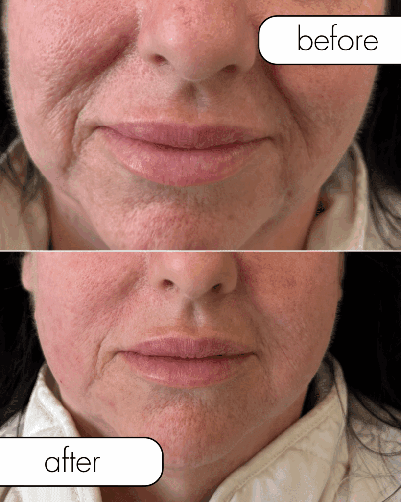 Before and after images of the lower face and jawline following hyperdilute Radiesse treatment, showcasing the natural, structure-based results possible with collagen stimulators for the body.