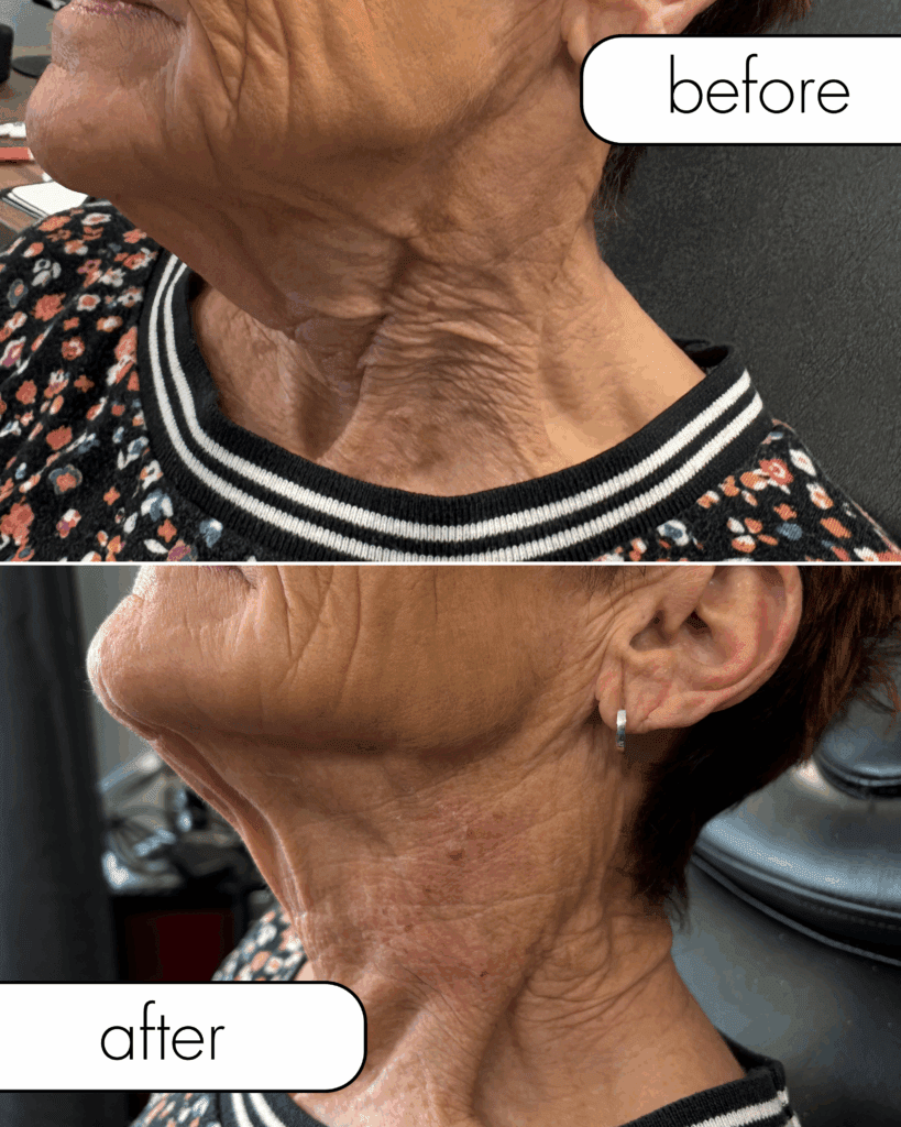 Before and after images of the neck treated with hyperdilute Radiesse, demonstrating how collagen stimulators for the body can firm and improve skin texture in delicate areas beyond the face.