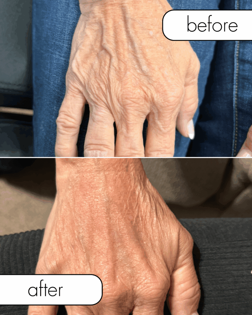 Before and after photos showing restored volume and smoother skin on the hands after treatment with hyperdilute Radiesse, highlighting the effectiveness of collagen stimulators for the body.