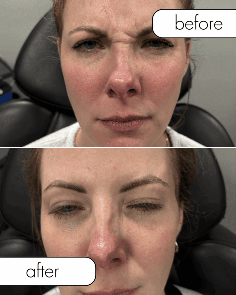 Before and after Botox from The Injectables Lounge
