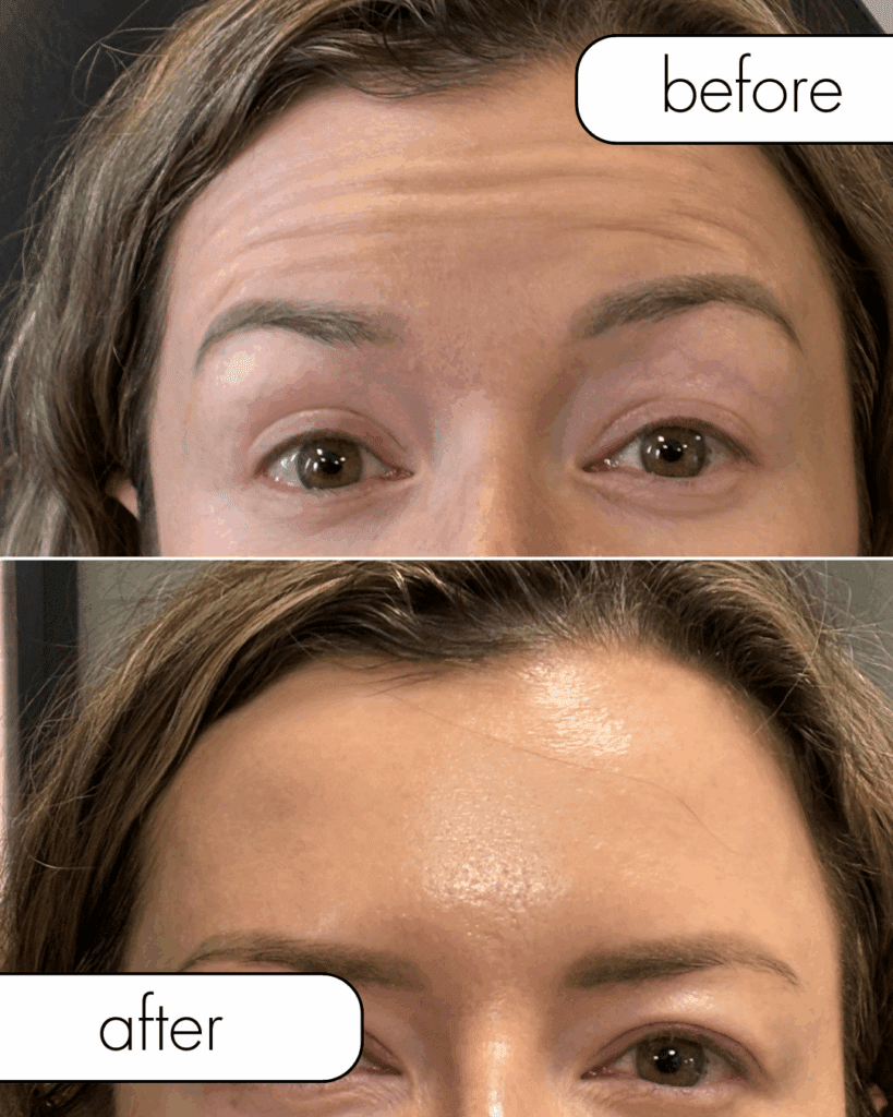 Before and after Botox from The Injectables Lounge