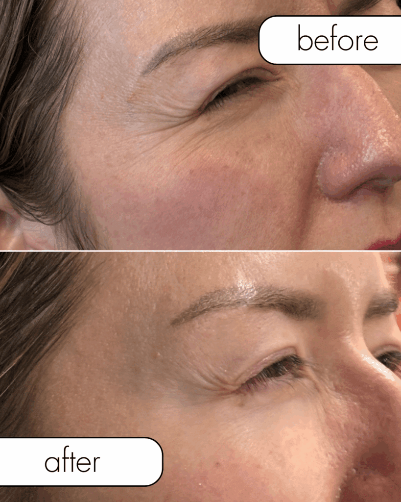 Before and after Botox from The Injectables Lounge