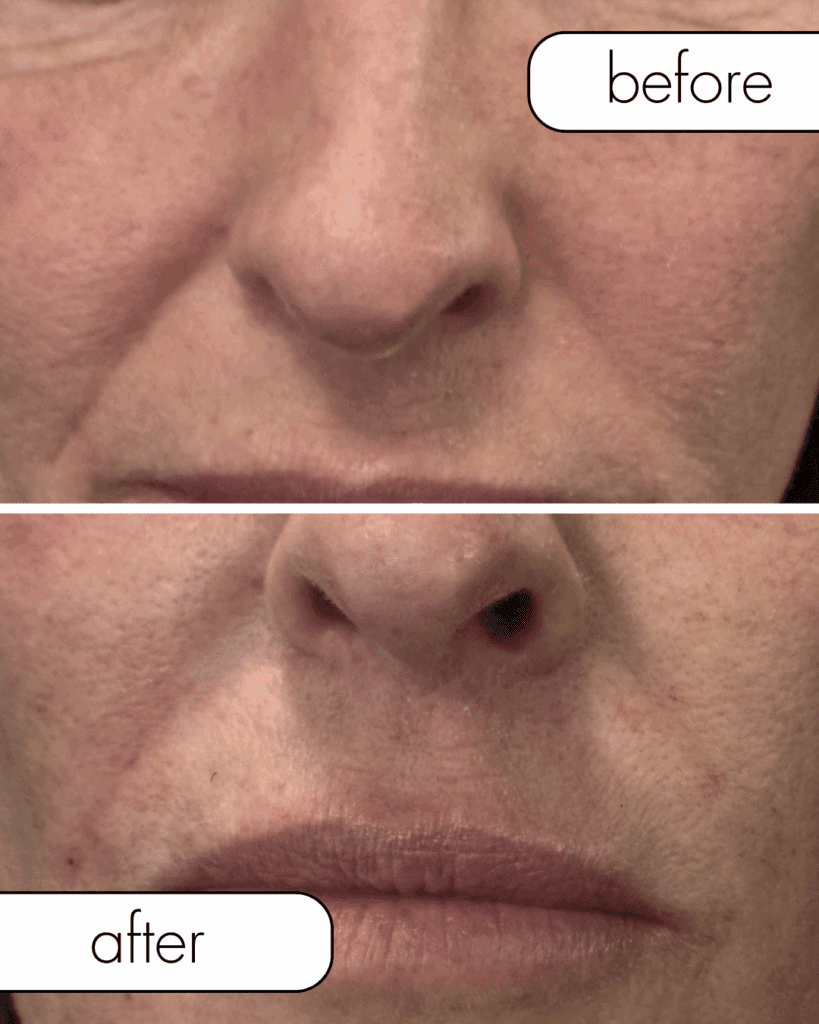 Before and after filler from The Injectables Lounge