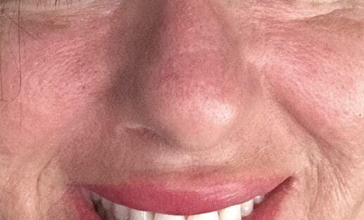Close-up of one woman’s nose over time highlighting skin texture changes, widened nasal tip, and soft tissue loss—illustrating age-related nasal changes