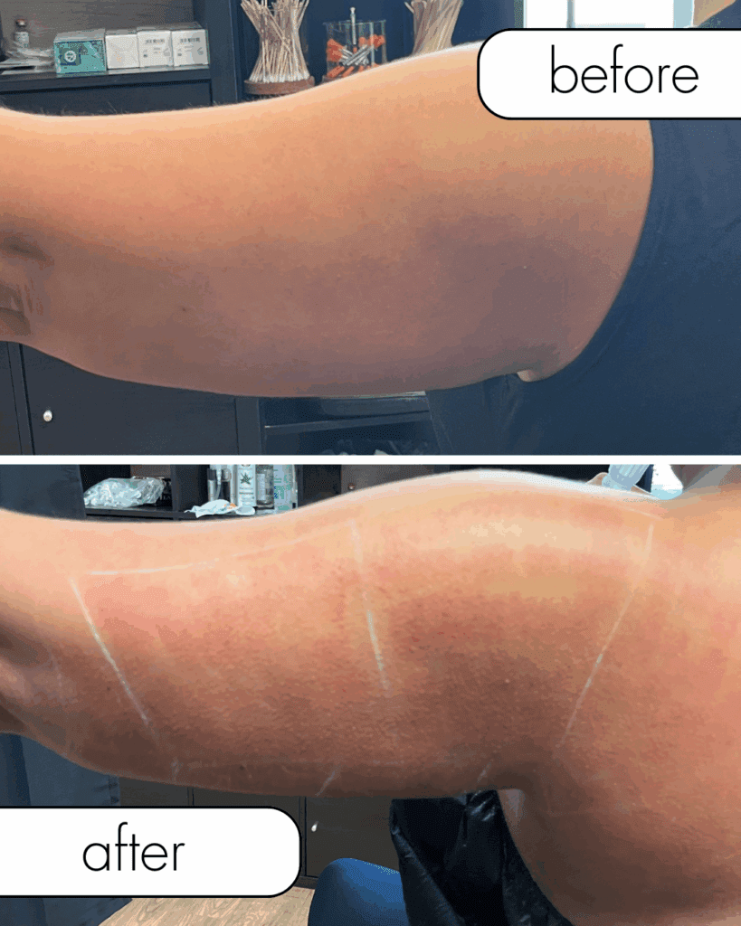 Before and after morpheus8 skin tightening on arm from The Injectables Lounge