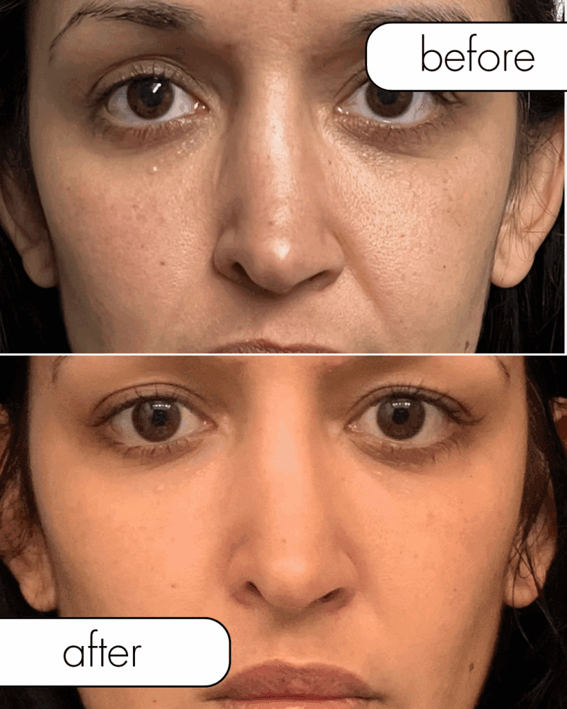 Before and after morpheus8 skin tightening on face from The Injectables Lounge