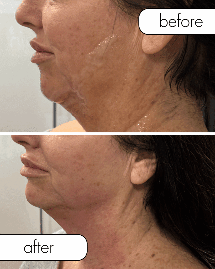 Before and after morpheus8 skin tightening on jawline from The Injectables Lounge