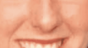 Side-by-side comparison of woman’s nose from age 17 to 50 showing subtle nasal tip drooping and changes in nose shape due to aging